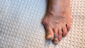 Złamany palec u nogi